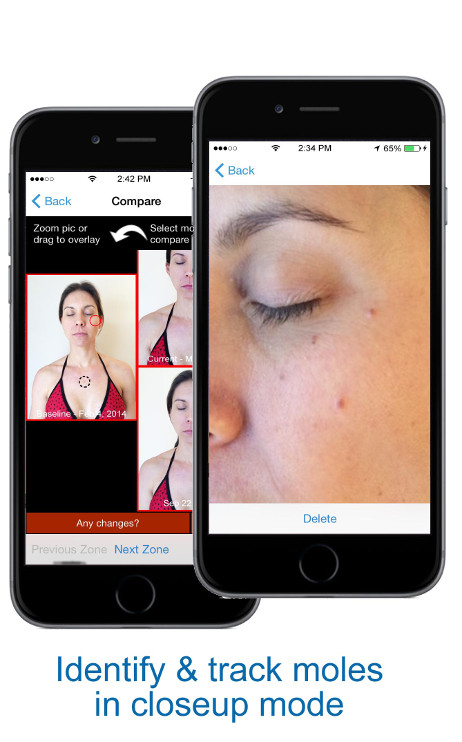 Identify & Track Moles in Close Up Mode - skin mapping with Compariskin